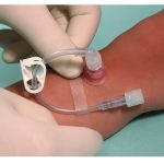 L’accesso intraosseo nel neonato