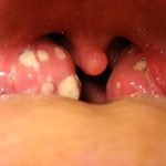 Non solo Covid, l'esperto: "Grave non cercare infezioni come lo streptococco nei bambini"