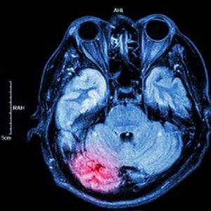 Traumi cerebrali: i benefici  della molecola NGF assunta per via nasale