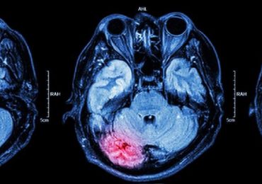 Traumi cerebrali: i benefici  della molecola NGF assunta per via nasale