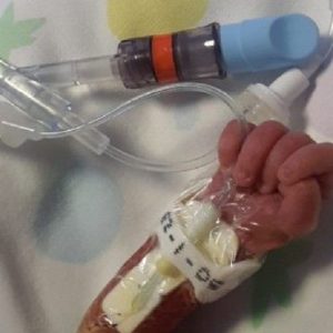 La contaminazione da particelle estranee durante le infusioni in ambito neonatale