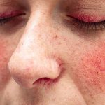 Rosacea: efficace nuova crema al perossido di benzoile microincapsulato al 5%