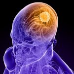 Tumori cerebrali, nuovo farmaco efficace nei topi: speranze per l'uomo?