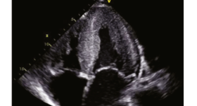 "Conoscere e curare l’Amiloidosi Cardiaca" Ecm gratuito per infermieri e medici