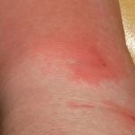 Erisipela: cause, diagnosi, terapia e complicanze