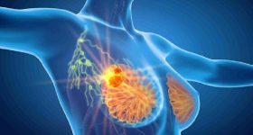 Tumore al seno, identificato meccanismo molecolare alla base delle forme più aggressive