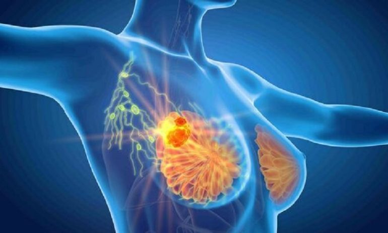 Tumore al seno, identificato meccanismo molecolare alla base delle forme più aggressive