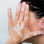Vitiligine: cause e trattamento
