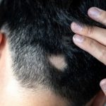 Alopecia areata, Fda approva Litfulo