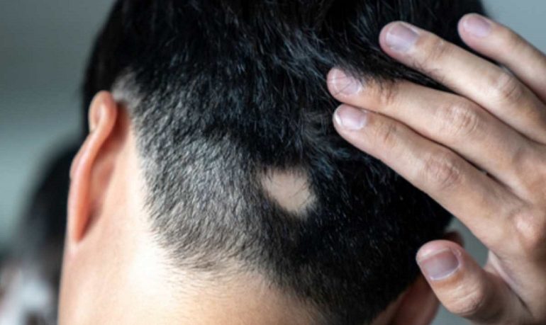 Alopecia areata, Fda approva Litfulo