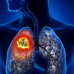Carcinoma polmonare non a piccole cellule, identificati nuovi biomarcatori