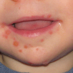 Malattia mani-piedi-bocca: sintomi, terapia e prevenzione