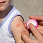 Punture di insetti in età pediatrica: i consigli della SIAIP