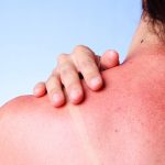 Ustioni solari: come proteggersi e quando preoccuparsi