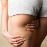 Cellulite: l'importanza di una corretta idratazione