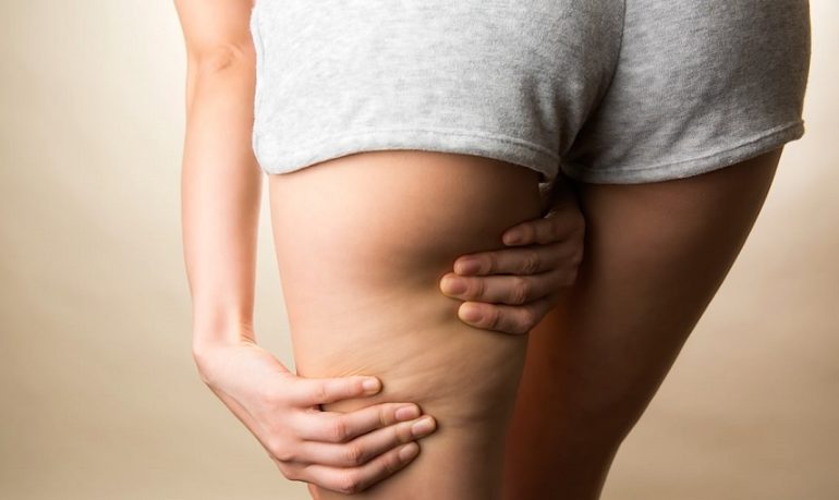 Cellulite: l'importanza di una corretta idratazione