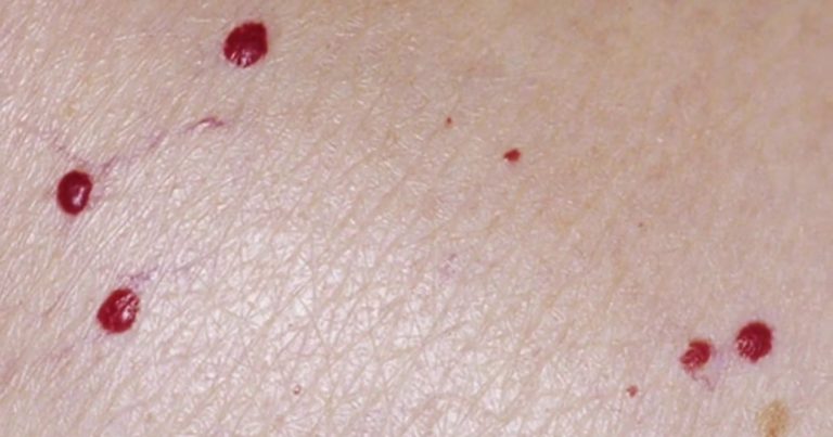 Nei rossi sulla pelle: cause, sintomi e trattamenti