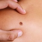 Gratti un neo e fuoriesce sangue: cosa significa?