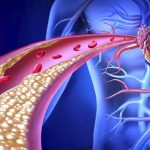 Ipercolesterolemia: i benfici dell'acido bempedoico