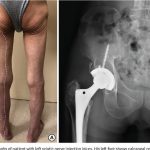 Lesioni causate da errata iniezione intramuscolare: un caso clinico di sciatalgia