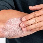 Psoriasi: tutto quello che c'è da sapere
