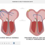 Sindrome di Wolff-Parkinson-White (WPW): cos'è e come si cura