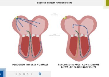 Sindrome di Wolff-Parkinson-White (WPW): cos'è e come si cura