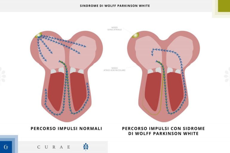 Sindrome di Wolff-Parkinson-White (WPW): cos'è e come si cura