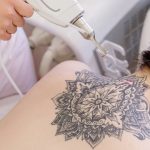 Tatuaggi: come rimuoverli e con quali rischi