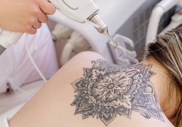 Tatuaggi: come rimuoverli e con quali rischi