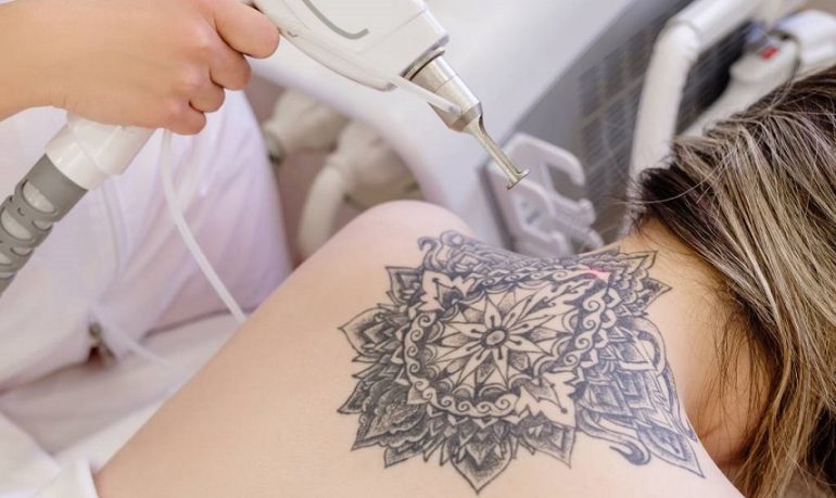 Tatuaggi: come rimuoverli e con quali rischi