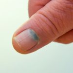 Tumore all'unghia: sintomi, diagnosi e stime di sopravvivenza