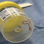 Verme vivo nel cervello di una donna: incredibile scoperta in Australia