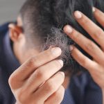 Alopecia areata, arriva il primo farmaco approvato