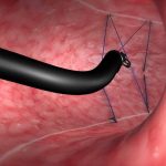 Chirurgia bariatrica, ecco endosleeve: nuovo intervento di riduzione dello stomaco