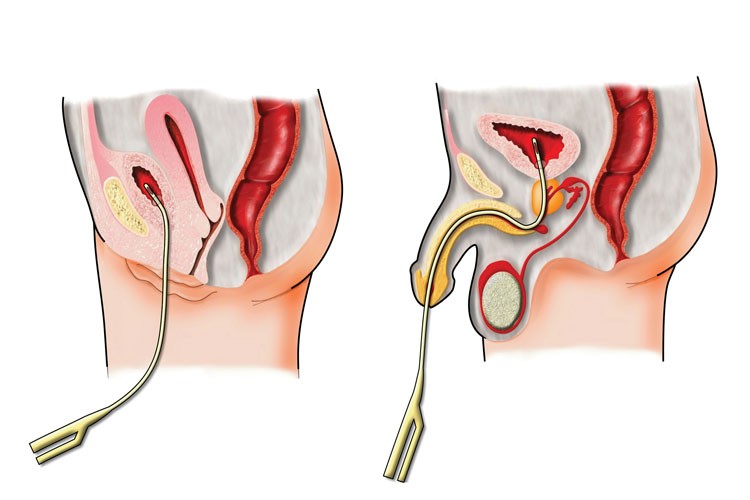 Il cateterismo vescicale: procedura, tipologie di presidio,