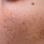 Macchie Solari: cause, sintomi, prevenzione e trattamenti efficaci per ridurne l’aspetto