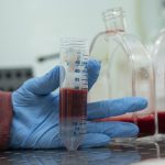 Sclerosi multipla: trapianto di staminali adatto per il trattamento