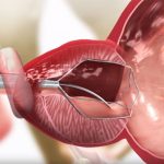 Stent prostatico: cos'è, come funziona, rischi e benefici