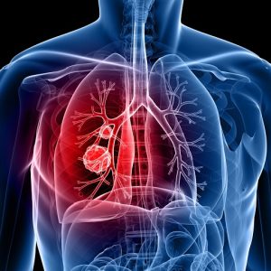 Tumore al polmone, arriva in Italia la prima immunoterapia adiuvante