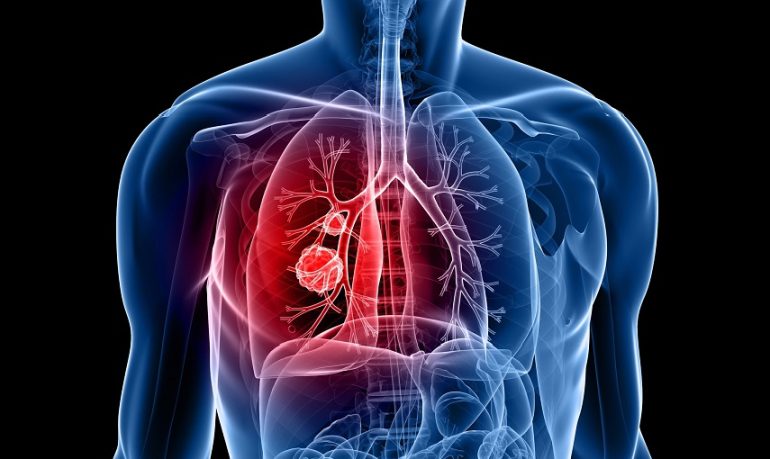 Tumore al polmone, arriva in Italia la prima immunoterapia adiuvante