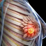Tumore al seno metaplastico può avere origine ereditaria: lo studio