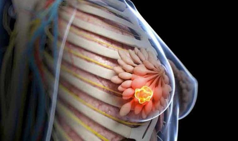 Tumore al seno metaplastico può avere origine ereditaria: lo studio
