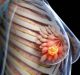 Tumore al seno metaplastico può avere origine ereditaria: lo studio