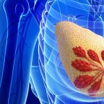 Tumore al seno: quando le microcalcificazioni sono un segnale d'allarme