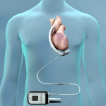 Al Monzino cuore artificiale di ultima generazione con tecnologia di levitazione magnetica