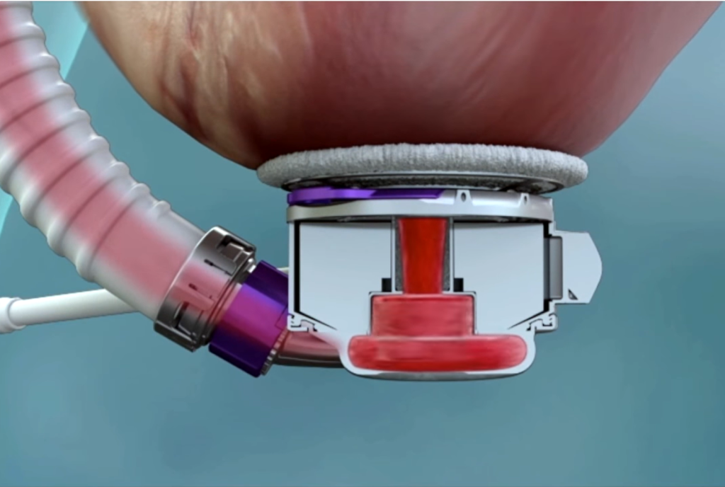 Al Monzino cuore artificiale di ultima generazione con tecnologia di levitazione magnetica 1
