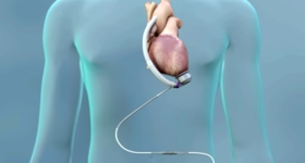 Al Monzino cuore artificiale di ultima generazione con tecnologia di levitazione magnetica