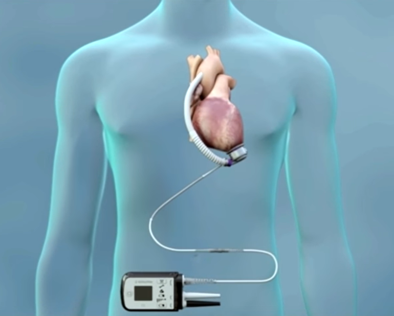 Al Monzino cuore artificiale di ultima generazione con tecnologia di levitazione magnetica