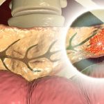 Cancro al pancreas: una combinazione di farmaci per "far morire di fame" le cellule tumorali